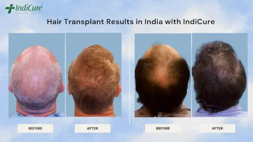 Hair Transplant Results in India with IndiCure Hair Transplant Results in India with IndiCure